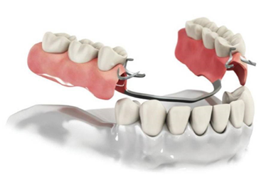 Съемное протезирование