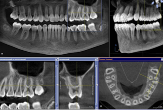 Компьютерная 3D томография зубных рядов