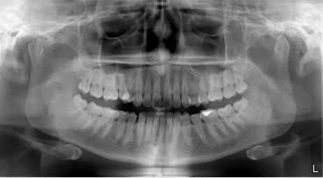 Ортопантомография