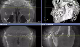 Томография височно-нижнечелюстного сустава