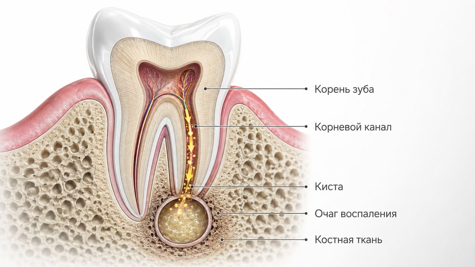 Киста зуба