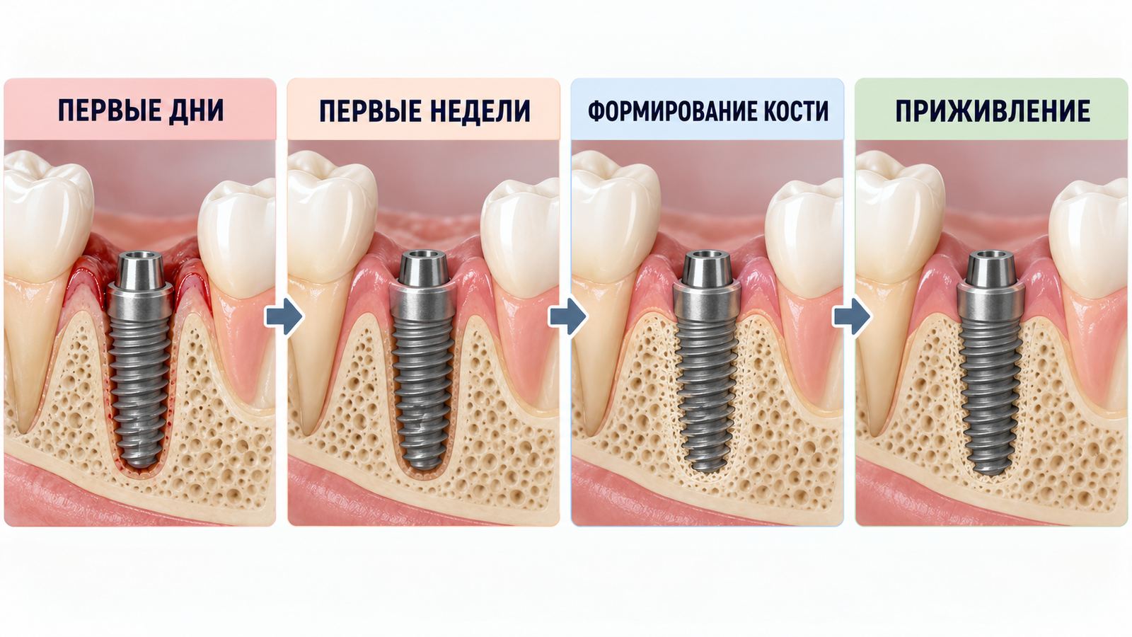 Приживаемость имплантов: сроки и этапы