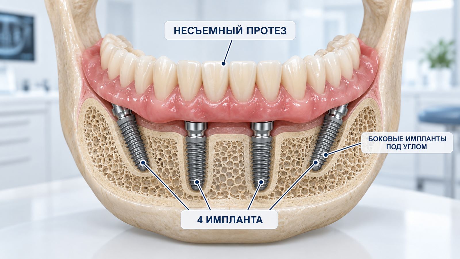 Протезирование все на 4