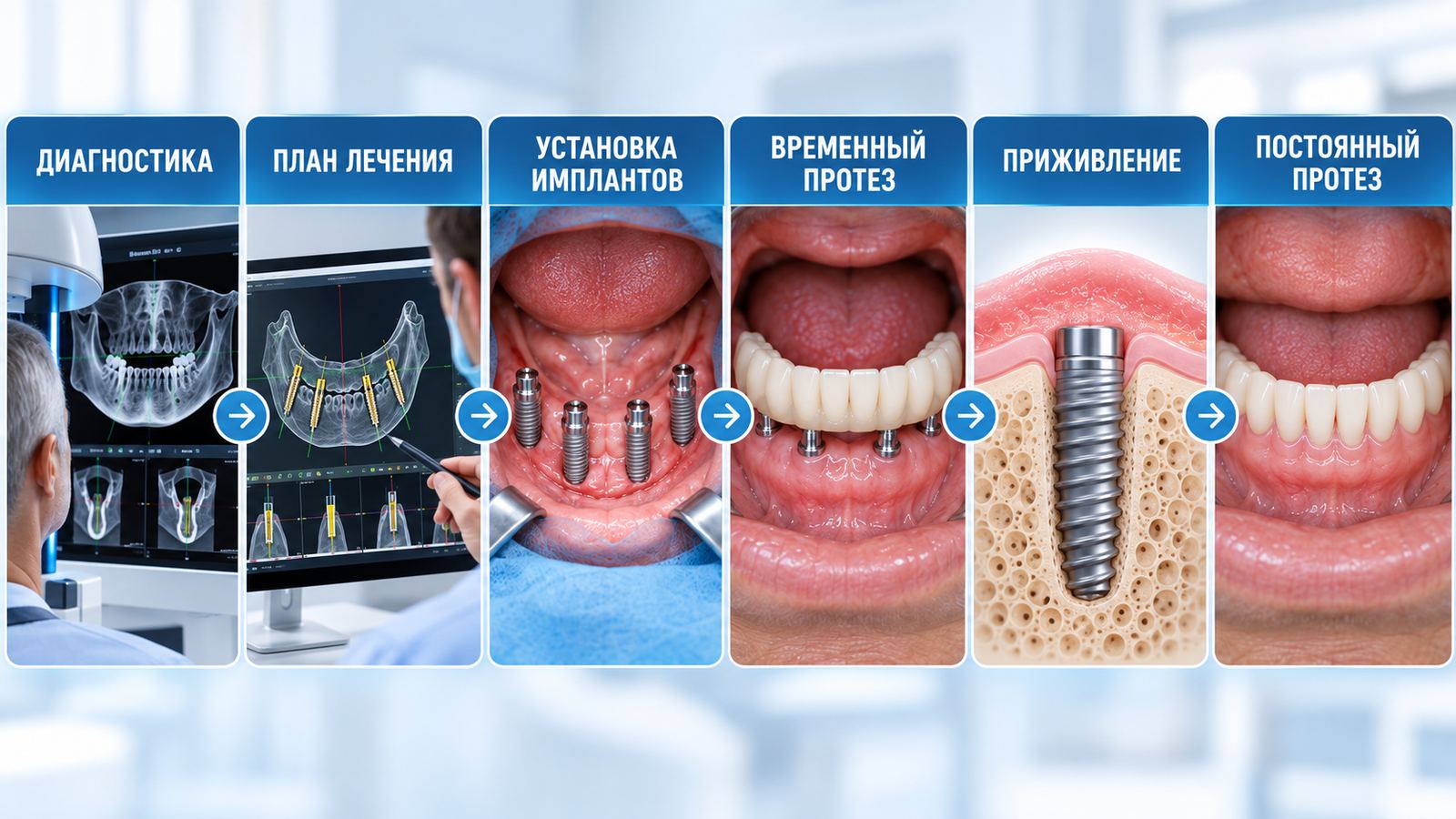 Протезирование все на 4